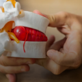 Hérnia de disco: sempre precisa de cirurgia?